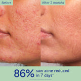 Vinopure Acne-Prone Skin Essentials