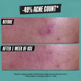 Acne Treating & Cleansing Face Wash with Salicylic Acid