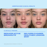 Clear Skin Acne Discovery Kit