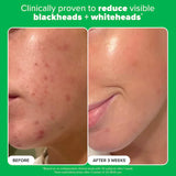 Complexion Clarity Duo with Salicylic Acid & Azelaic Acid