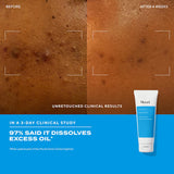 Clear Skin Acne Discovery Kit