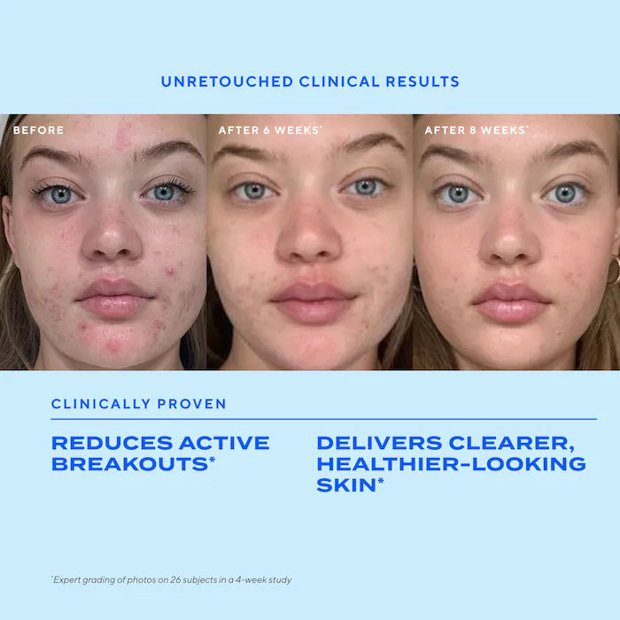 Clear Skin Acne Discovery Kit